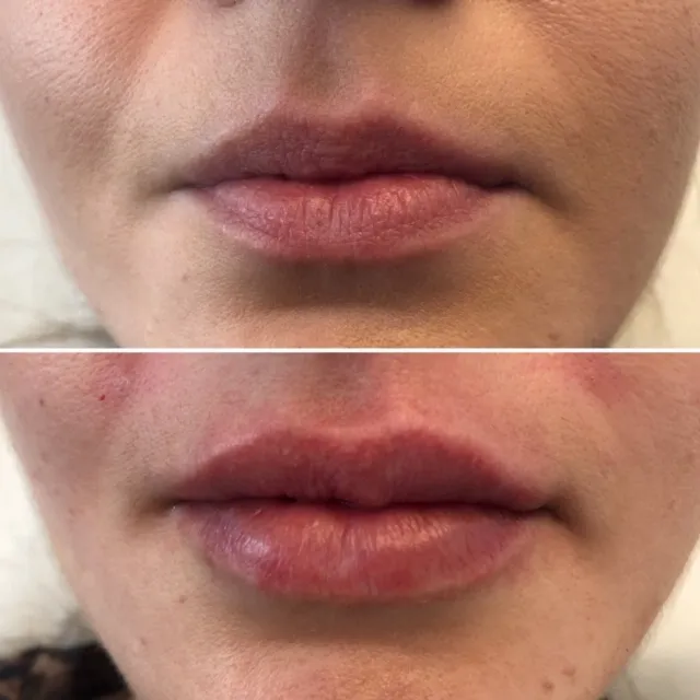 Modelowanie ust kwasem hialuronowym — efekt zabiegu